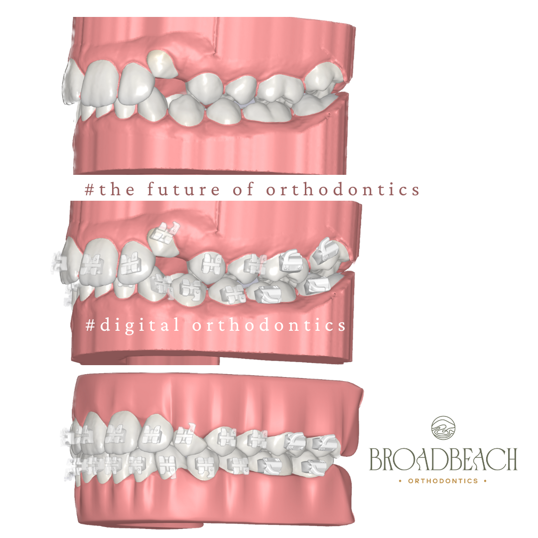 The Future of Smiles with Digital Orthodontics for Teens