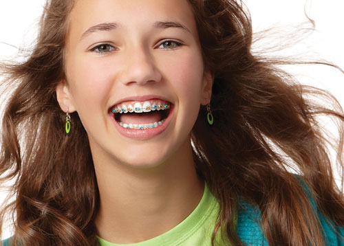 “Girl Math” in Orthodontics: Making Sense of Metal Braces