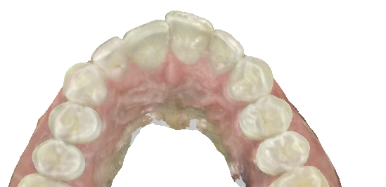 One tooth is out of position, do I need braces?