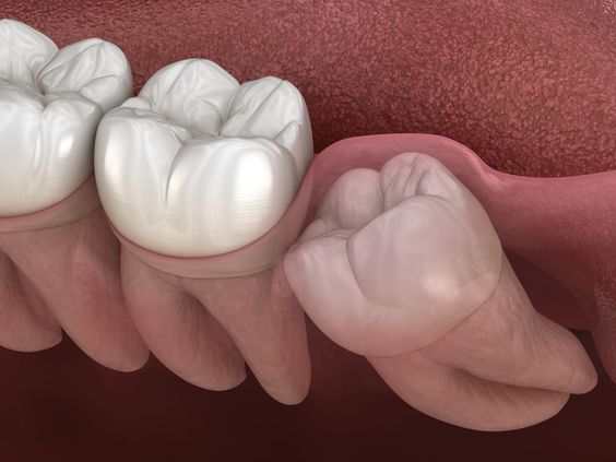 Braces and Wisdom Teeth: What You Need to Know