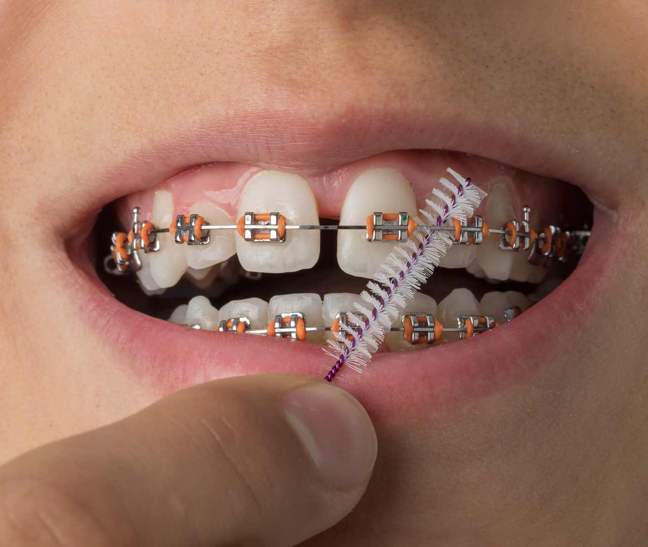 How to take care of your braces?