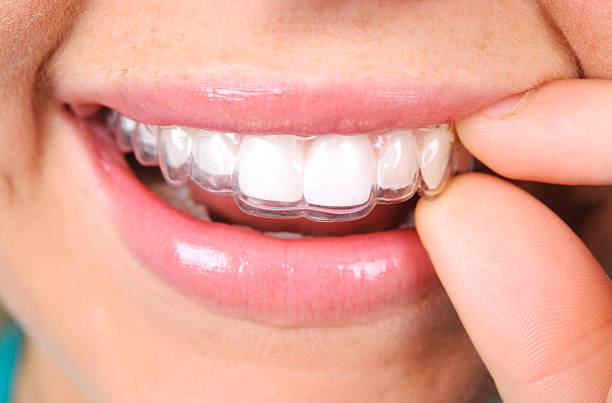 Dealing with Tight Retainers: What You Need to Know