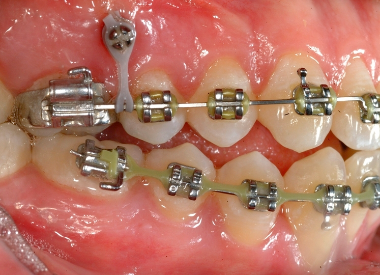 What are TADs in orthodontics?