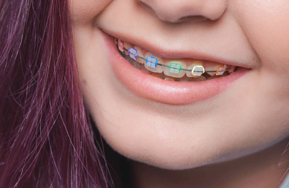 What to Expect at Your Braces Tightening (adjustment)Appointment?