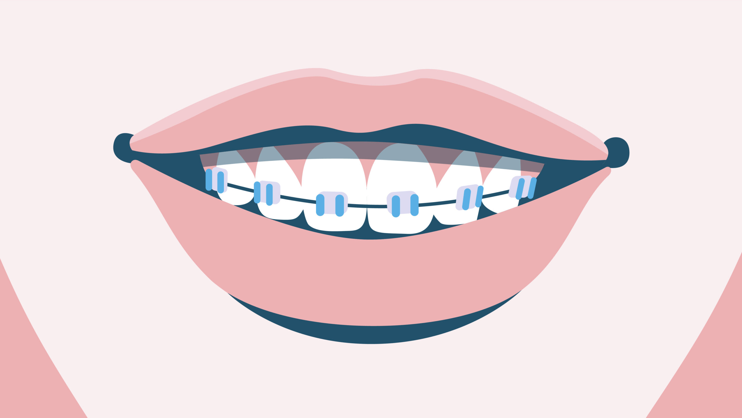 How do braces actually work? - Broadbeach Orthodontics