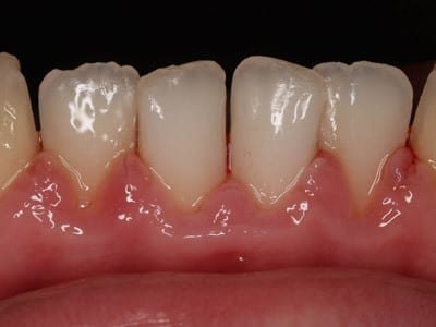 My orthodontist wants to do something called enamel stripping to reshape my teeth and make my teeth smaller. I have never heard of this. Is this something new? Is it safe?