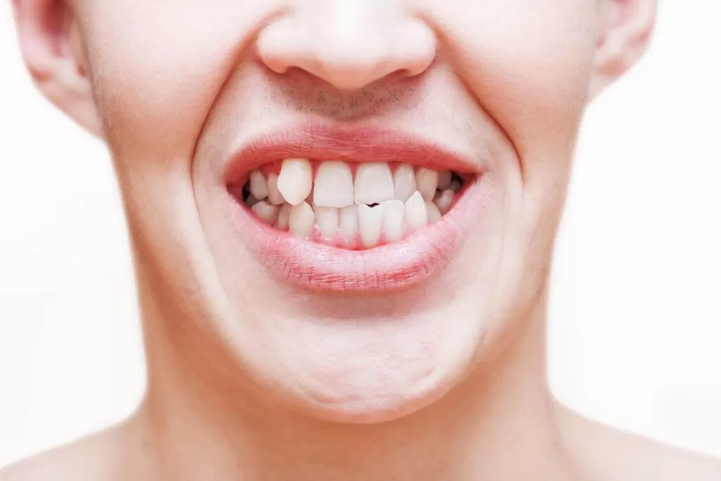 Complications of an Untreated Crossbite