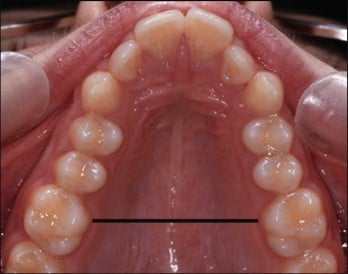 When and how to fix a narrow jaw?