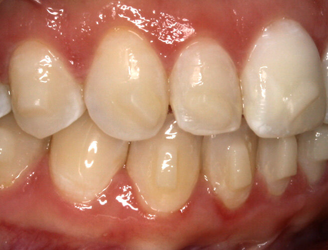 What is the purpose of attachments in aligners?