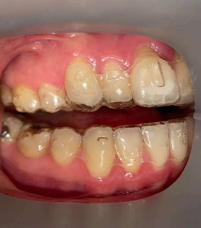 Aligners-gaps