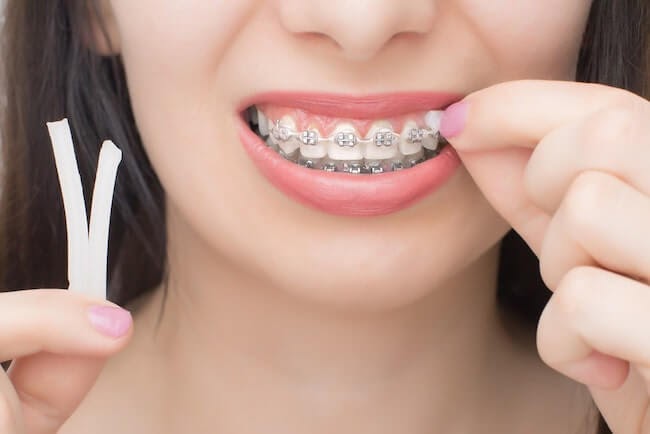 Orthodontic Wax for Braces: How to Use and When to Apply