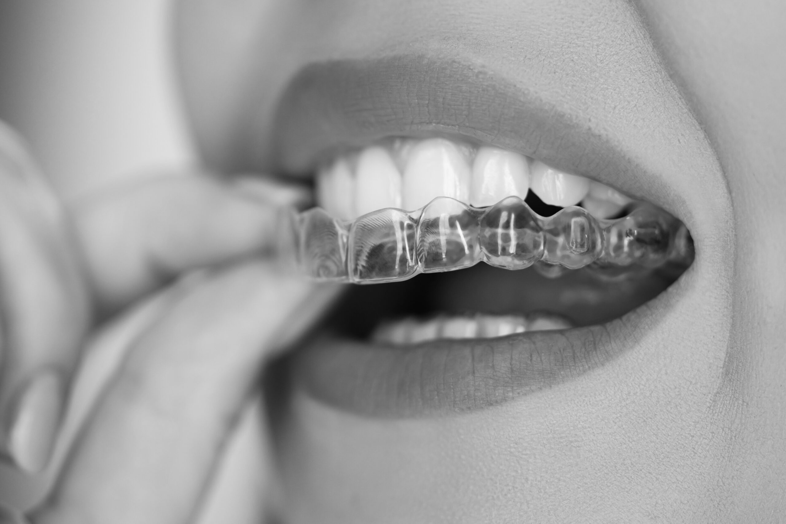 What happens if I wear my aligners part time? - Broadbeach Orthodontics