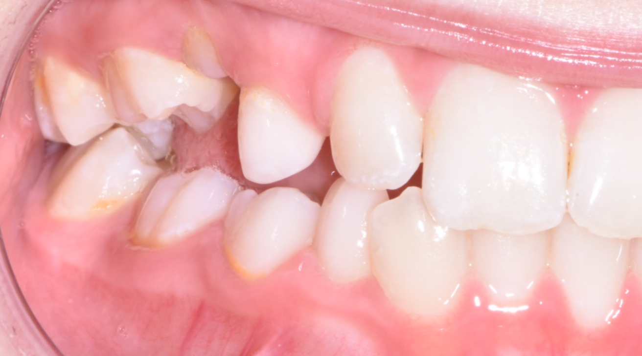 Primary Tooth Ankylosis: Why Early Orthodontic Assessment is Crucial ...